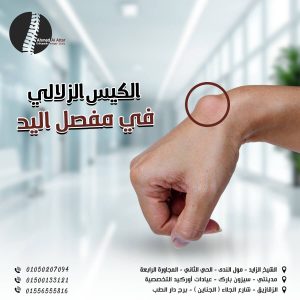 الكيس الزلالي في مفصل اليد