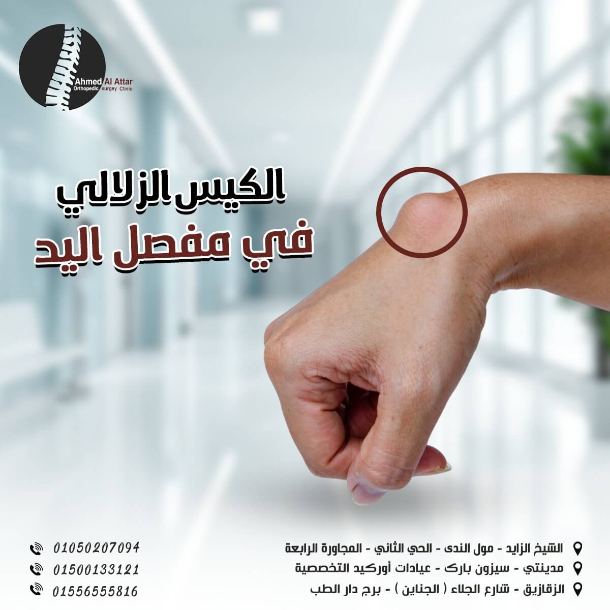 الكيس الزلالي في مفصل اليد التشخيص والعلاج | د. أحمد العطار