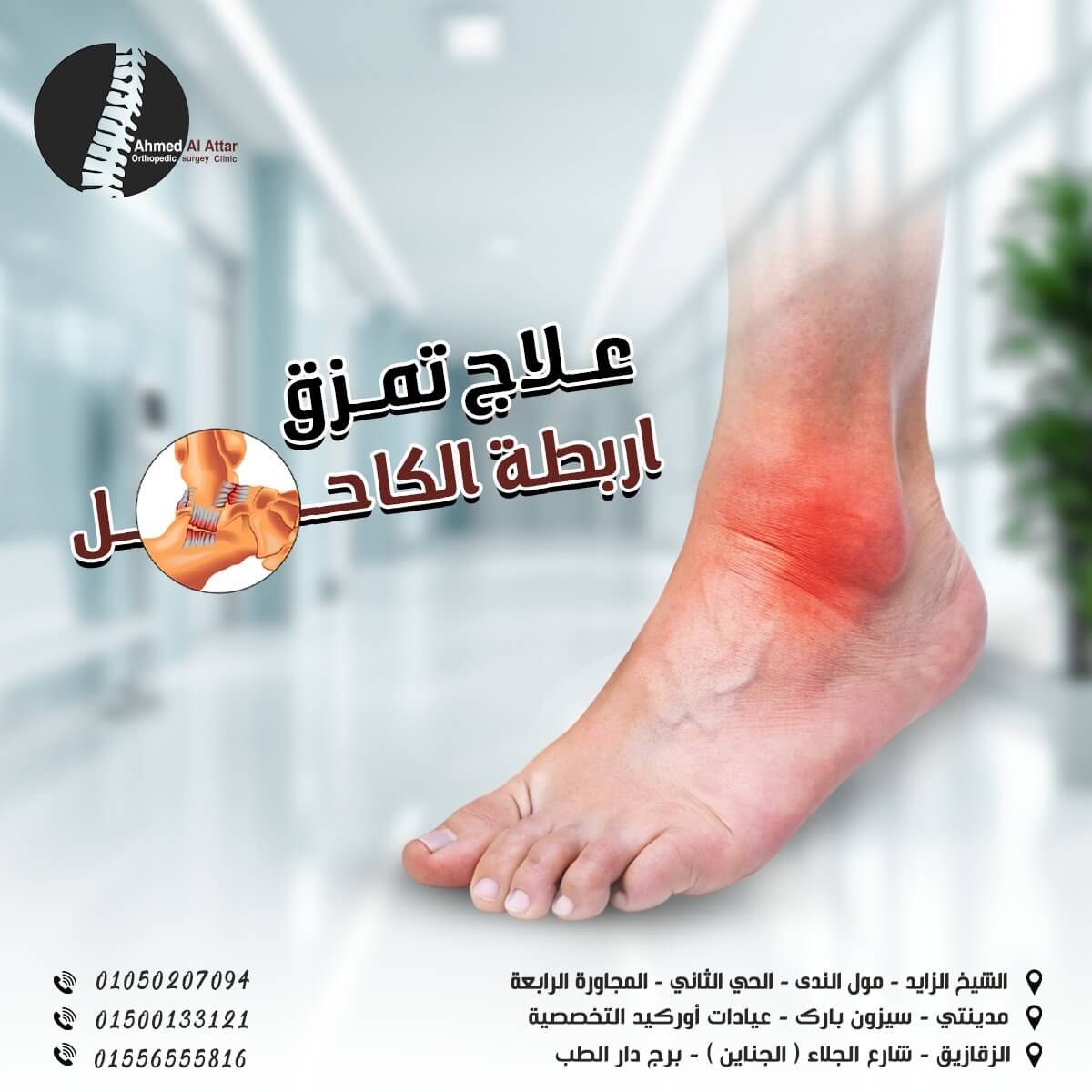 علاج تمزق اربطة الكاحل مع الدكتور احمد العطار!
